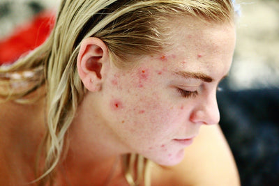 Is There An Acne Cure?